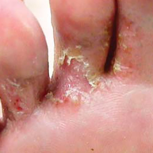 Athlete’s Foot